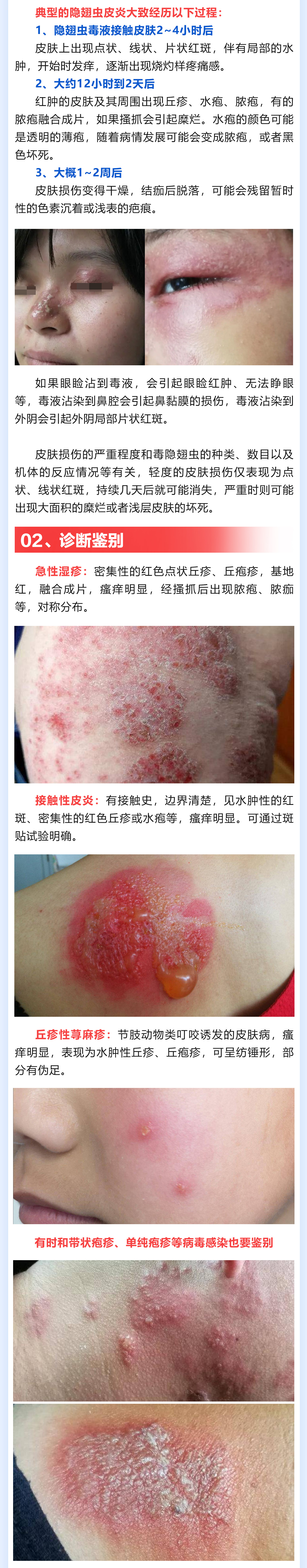 185期-隱翅蟲皮炎_02(1).jpg